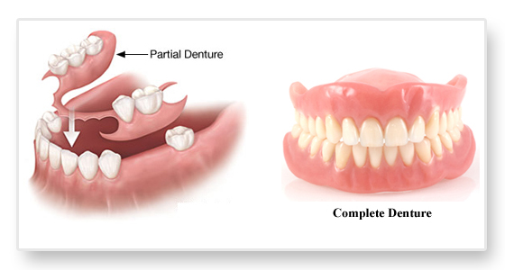 illstration showing partial an complete dentures in Turkey with Dantique Clinic