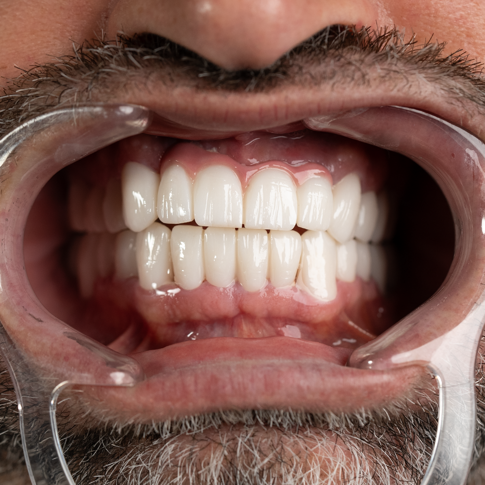 After Hollywood Smile Result X - Dentique Clinic