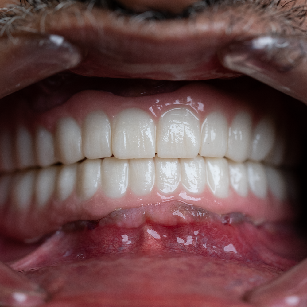 After Hollywood Smile Result X - Dentique Clinic