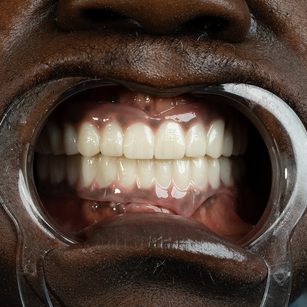 After Hollywood Smile Result X - Dentique Clinic