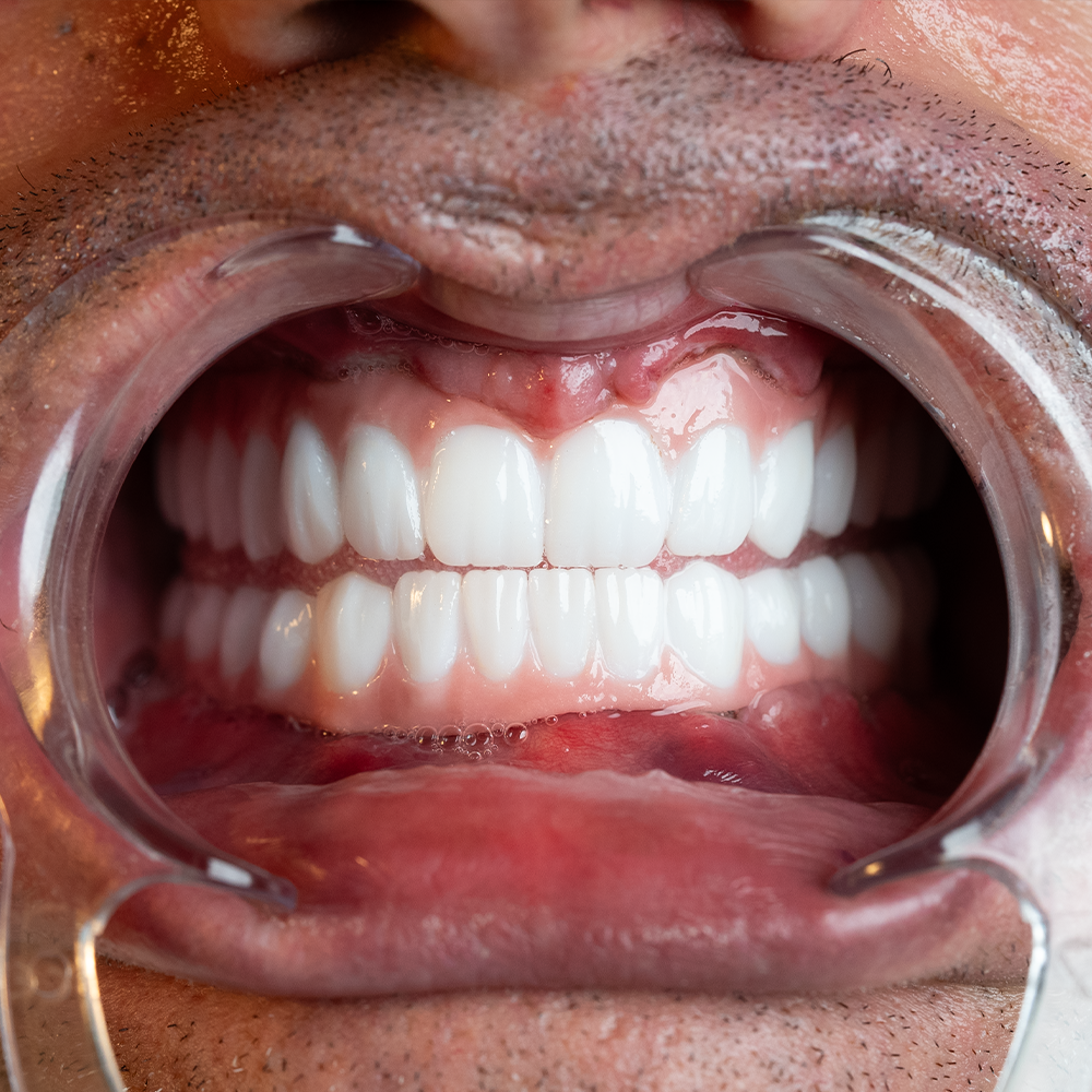 After Hollywood Smile Result X - Dentique Clinic