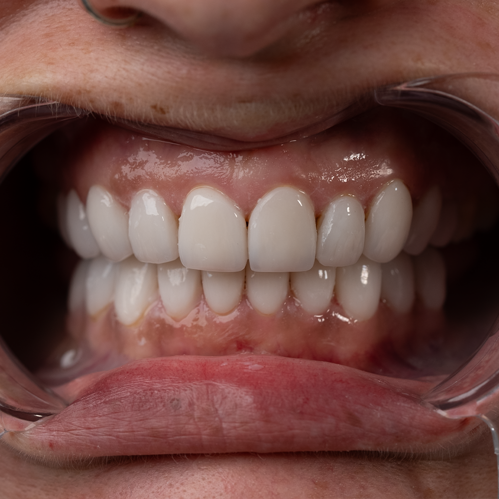 After Hollywood Smile Result X - Dentique Clinic