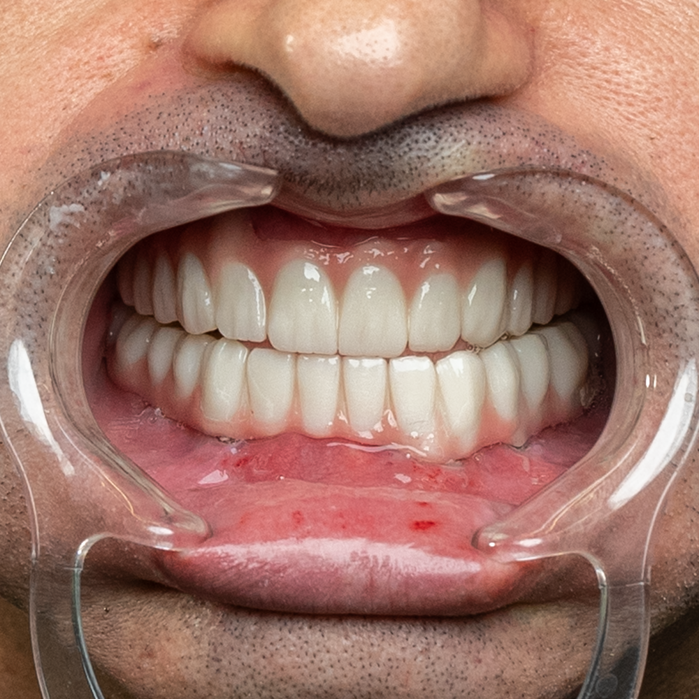 After Hollywood Smile Result X - Dentique Clinic