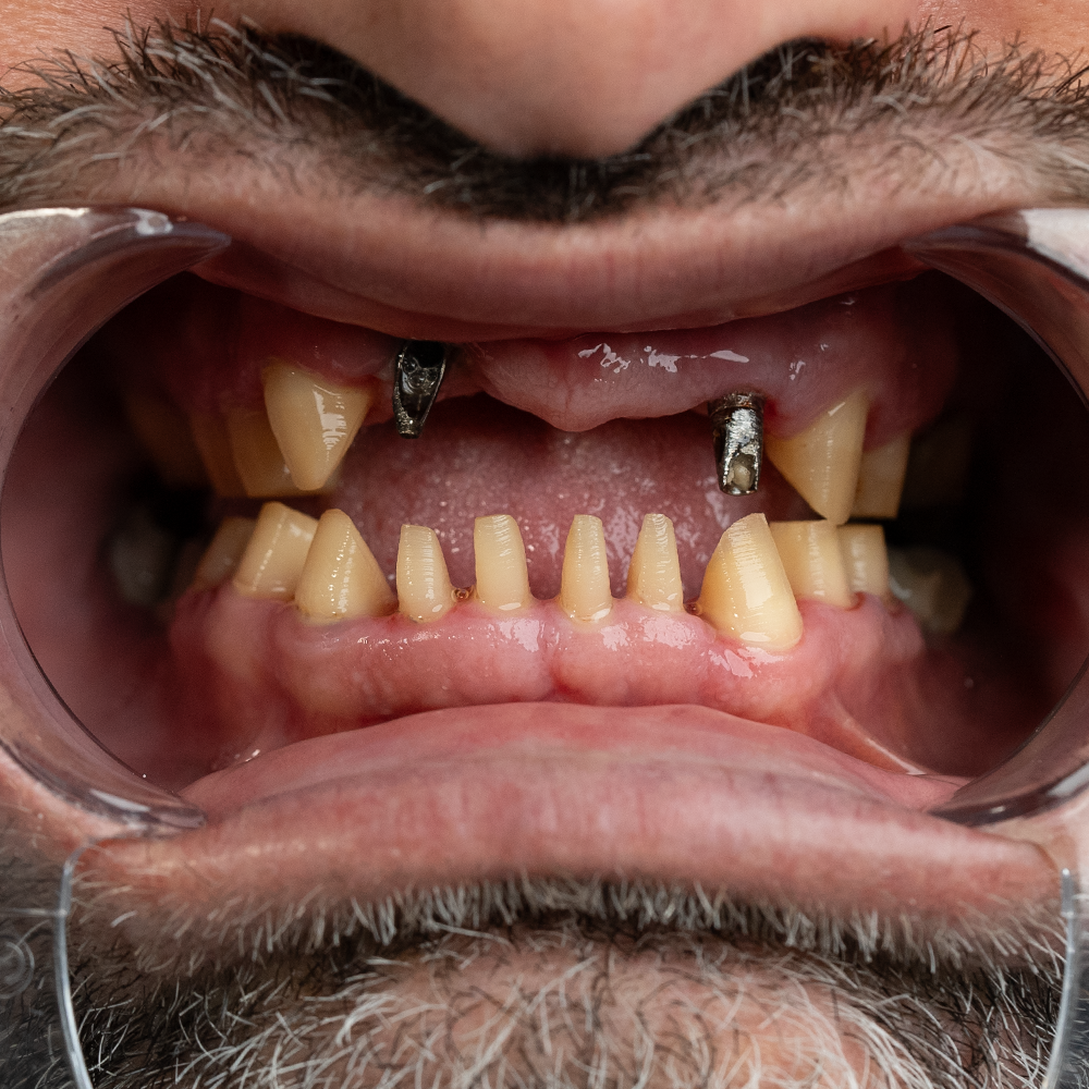 Before Hollywood Smile Result X - Dentique Clinic