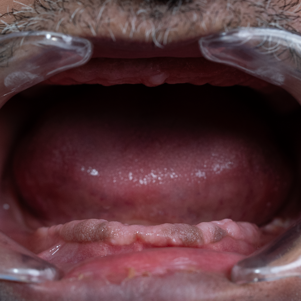 Before Hollywood Smile Result X - Dentique Clinic