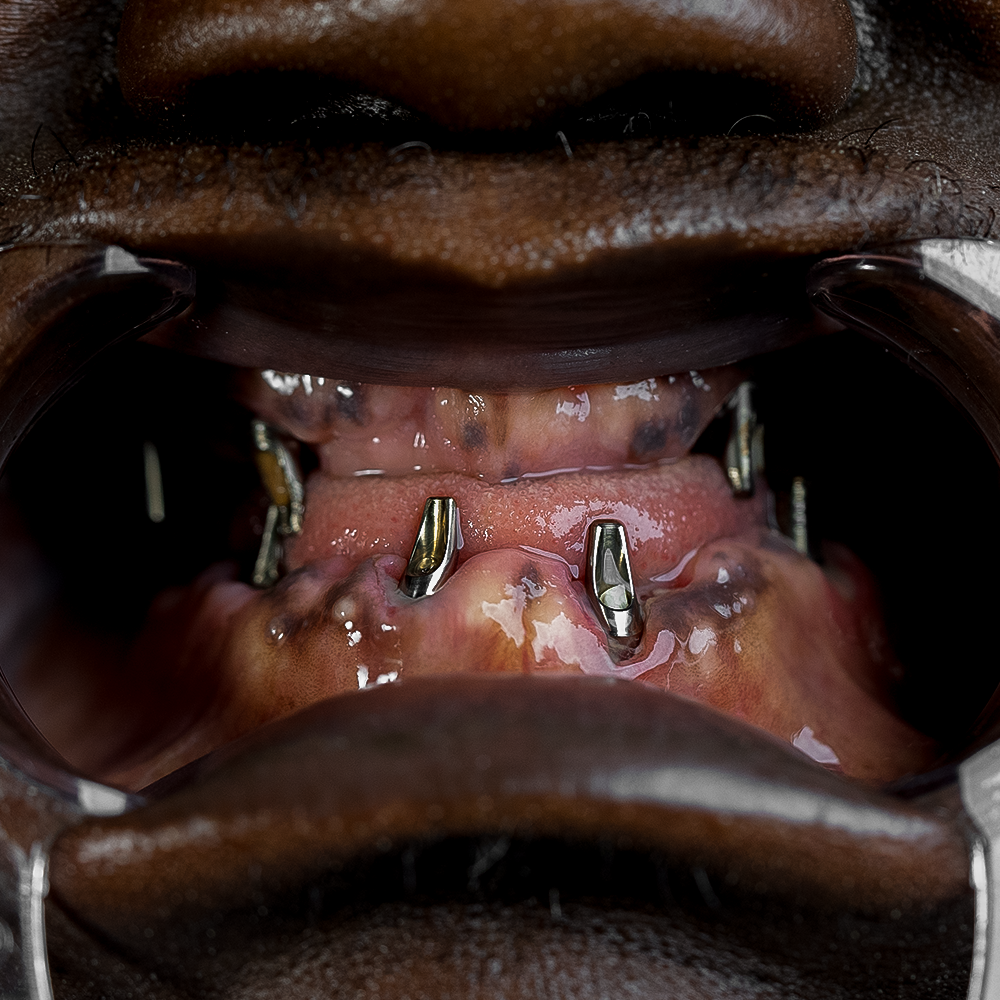 Before Hollywood Smile Result X - Dentique Clinic