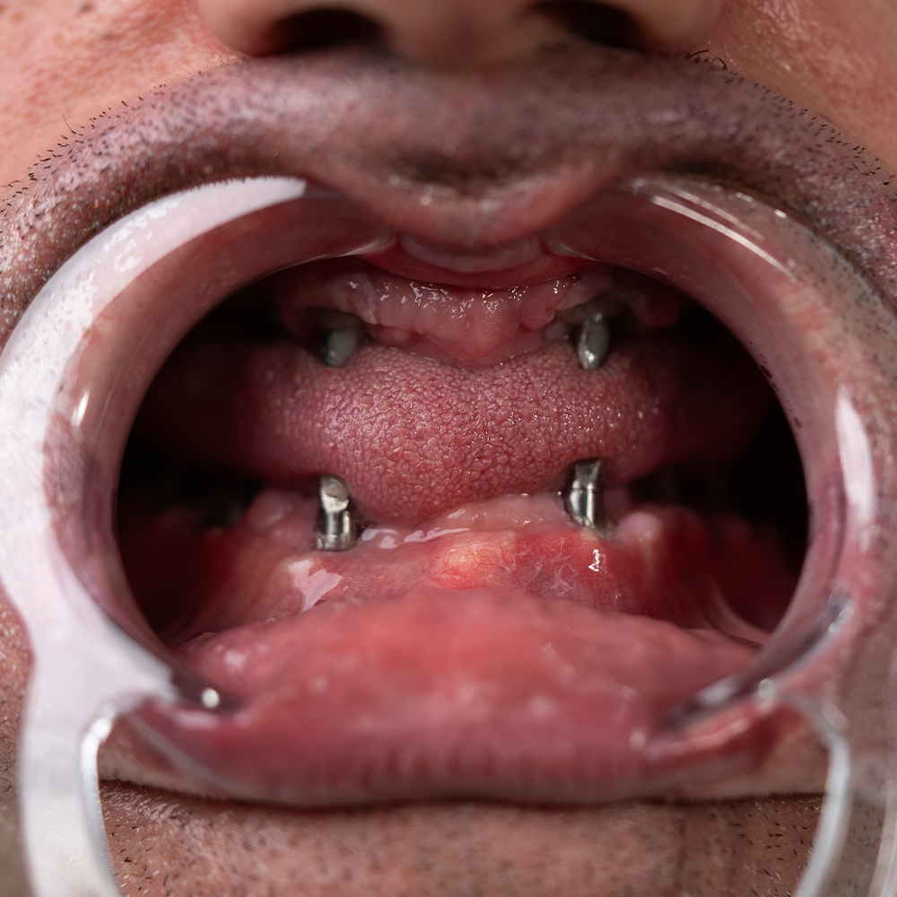 Before Hollywood Smile Result X - Dentique Clinic