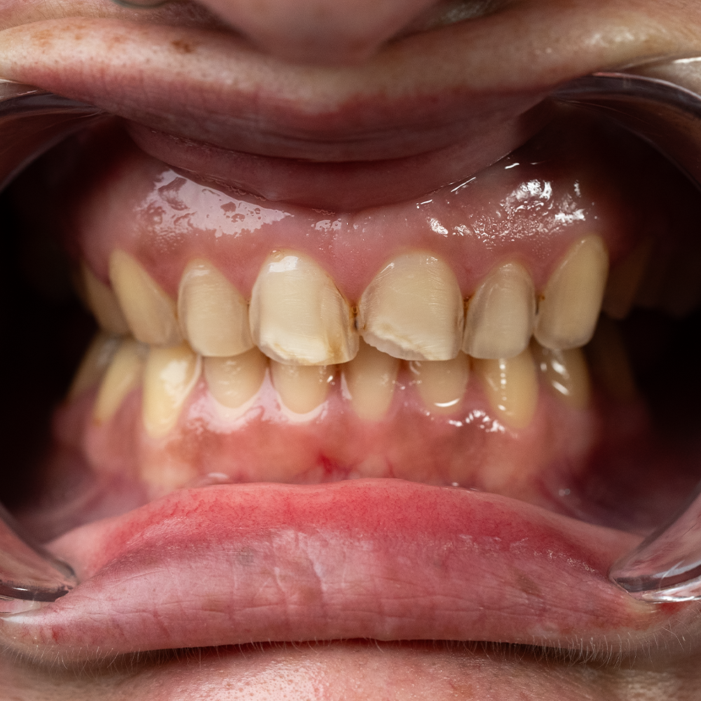 Before Hollywood Smile Result X - Dentique Clinic