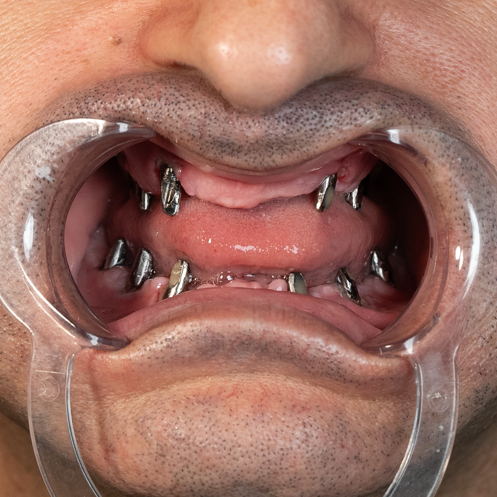 Before Hollywood Smile Result X - Dentique Clinic