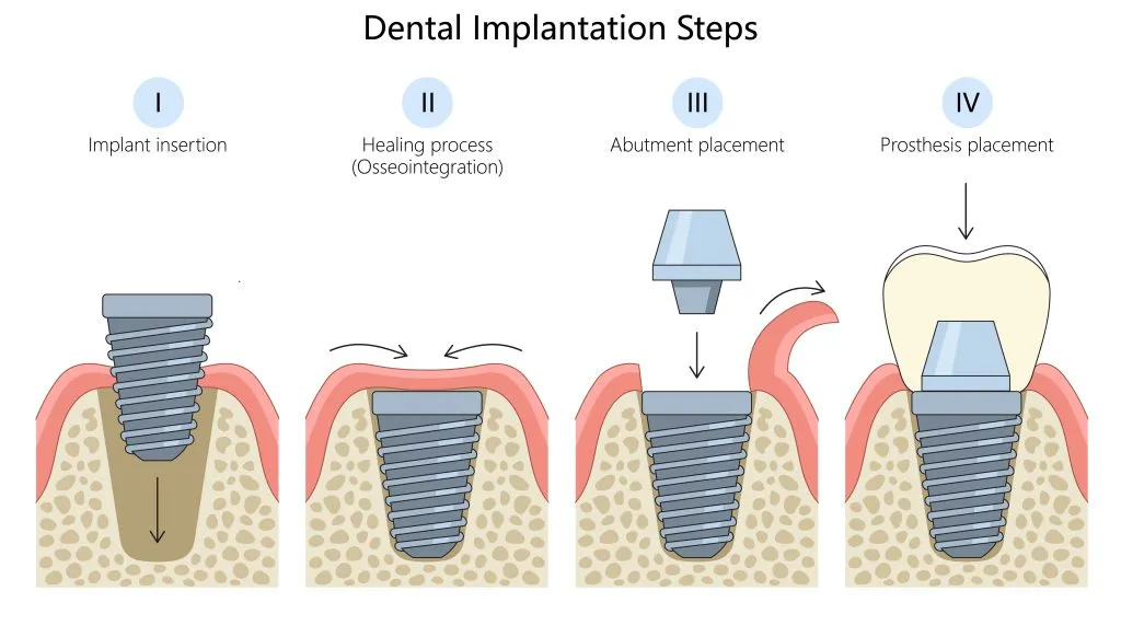 Illustration showing the Dental Implant Process With Dentique In Turkey