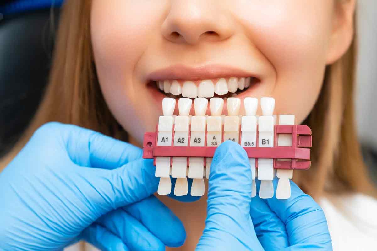 A close-up photo of a dental technician in Dentique clinic in Turkey placing a custom-made molar Dental-veneers onto a white stone model of a patient's teeth.