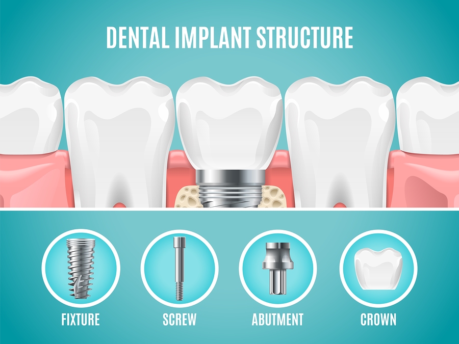 An illustration showing the Dental Implant Structure at Dentique clinic In Turkey