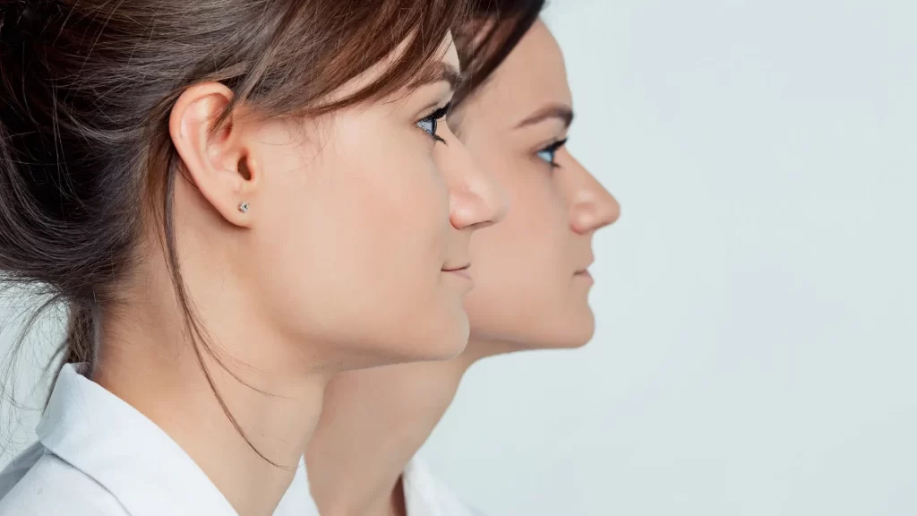 A close-up photo of a patient's face change after jaw surgery in Turkey with Dentique